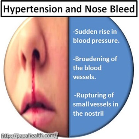 Hypertension-and-Nose-Bleed